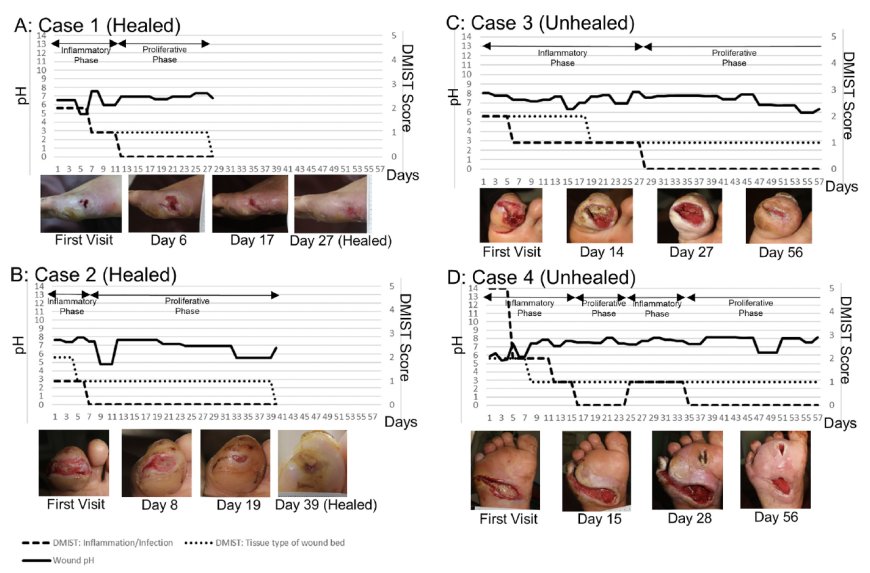 Trigona Honey Effect on Wound pH and Healing in Diabetes Related Foot  Ulcers: : A Case Series