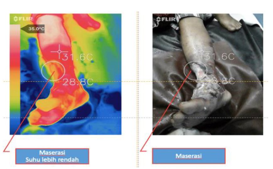 Pendampingan  Deteksi  Dini  Maserasi  Pada Luka Kaki  Diabetik Menggunakan Flir One One Smartphone  Thermography