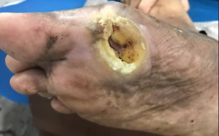 A Randomized Clinical Trial Study on the Prevention Strategy and Early Detection of Ulcer Recurrence in Patients with Type 2 Diabetes Mellitus Using the Risk of Recurrence Ulcer Tool