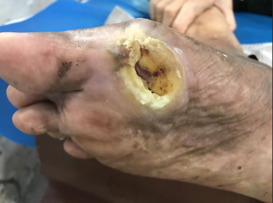 A Randomized Clinical Trial Study on the Prevention Strategy and Early Detection of Ulcer Recurrence in Patients with Type 2 Diabetes Mellitus Using the Risk of Recurrence Ulcer Tool